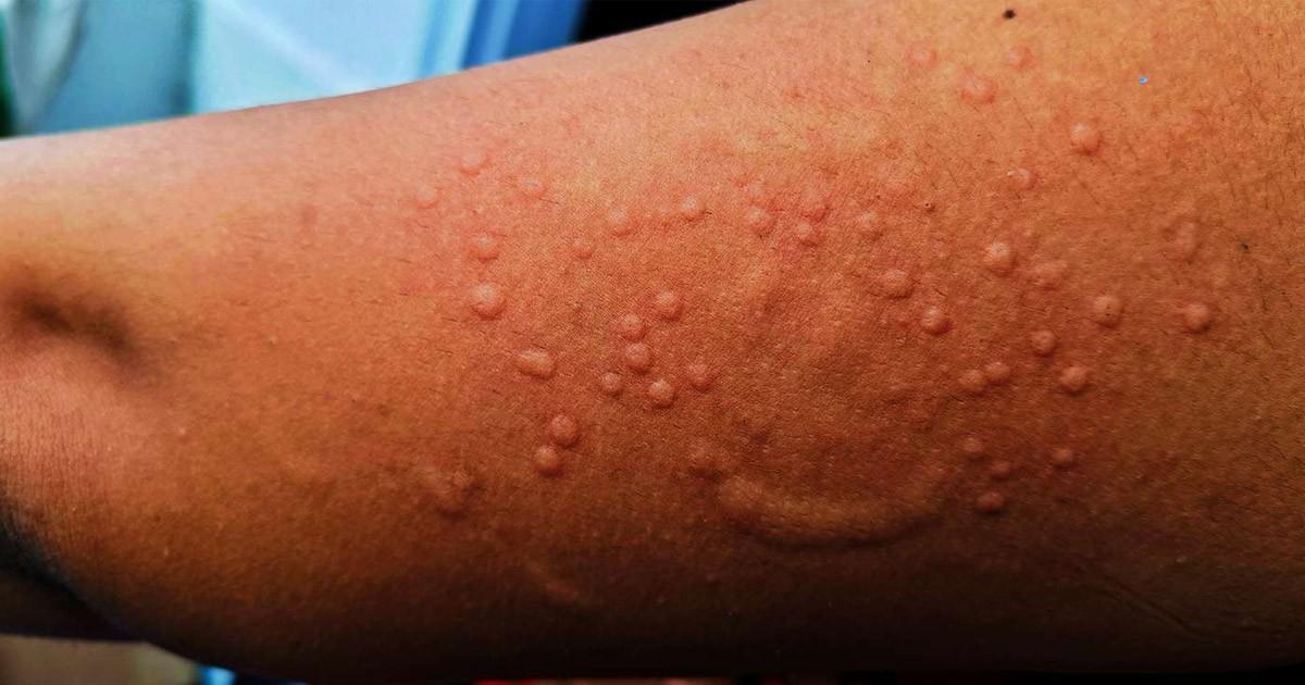 mpox Ευλογιά των Πιθήκων