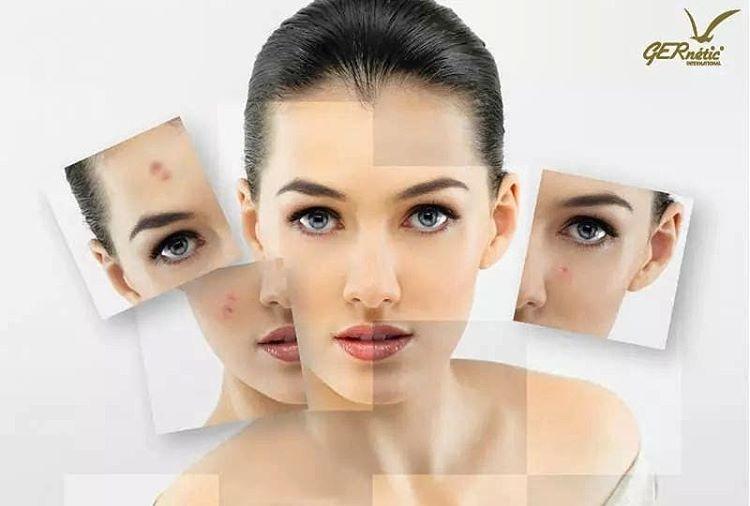 Πώς θα απαλλαγείτε από την ενοχλητική ακμή