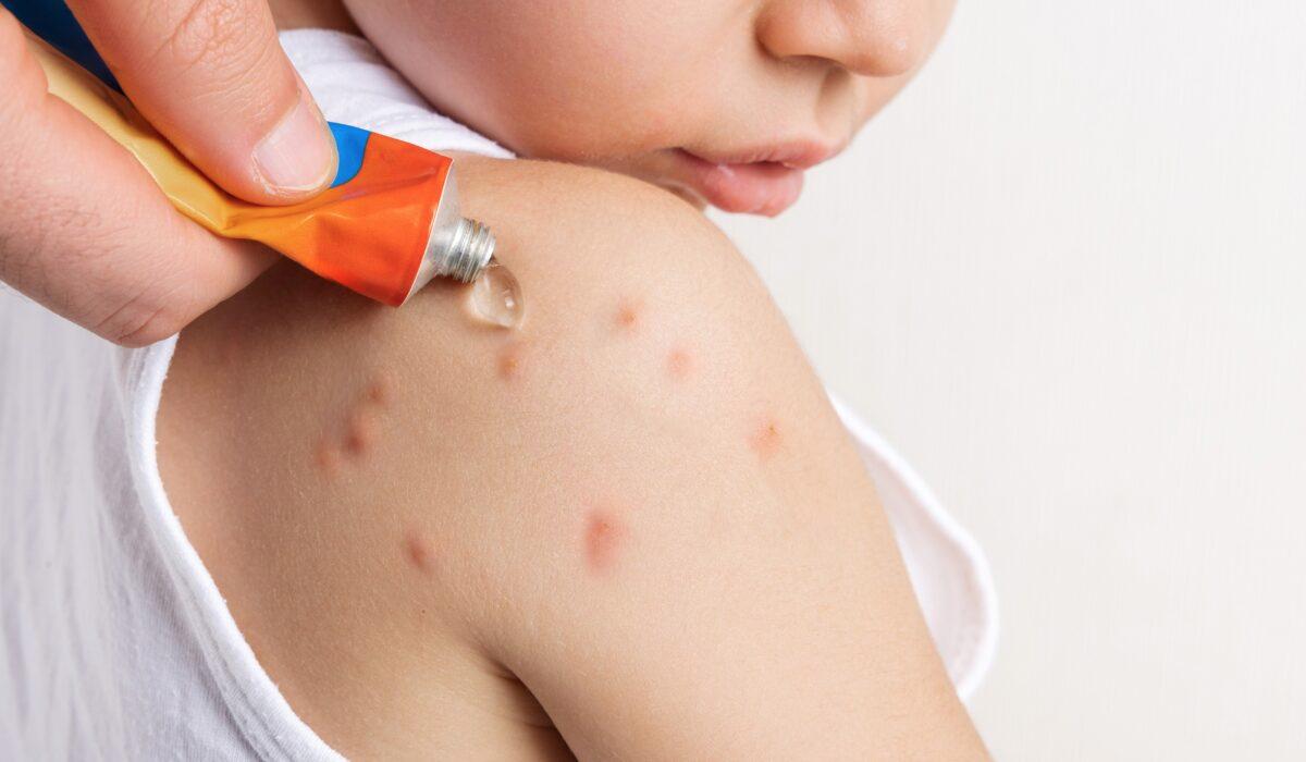 Ο οδηγός σας για τα τσιμπήματα από έντομα