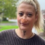 Εφιάλτης στην Τουρκία: Βρετανίδα “έχασε” τη μύτη της