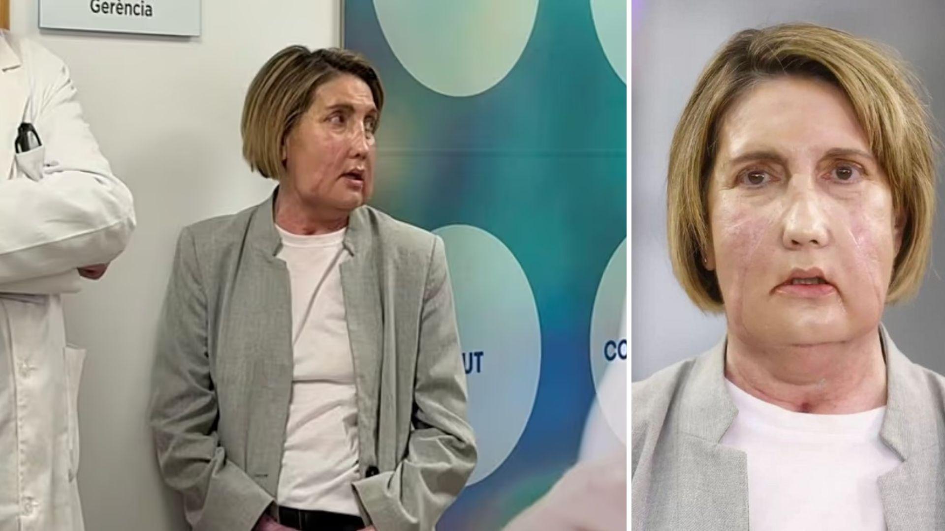 Ισπανία: Η πρώτη μεταμόσχευση προσώπου με δότρια που υποβλήθηκε σε ευθανασία