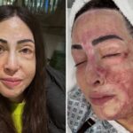 Ιωάννα Παλιοσπύρου: Εικόνες από την αποκατάσταση μετά την επίθεση με βιτριόλι