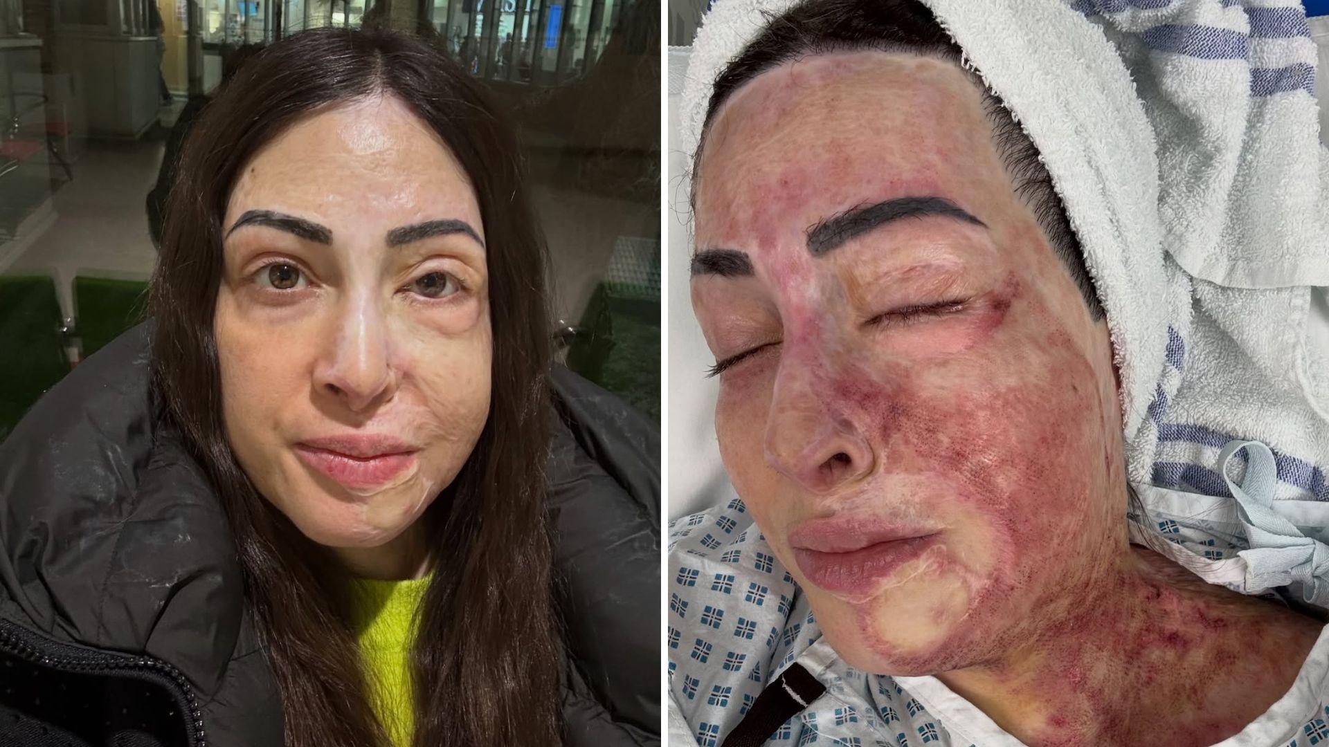 Ιωάννα Παλιοσπύρου: Εικόνες από την αποκατάσταση μετά την επίθεση με βιτριόλι