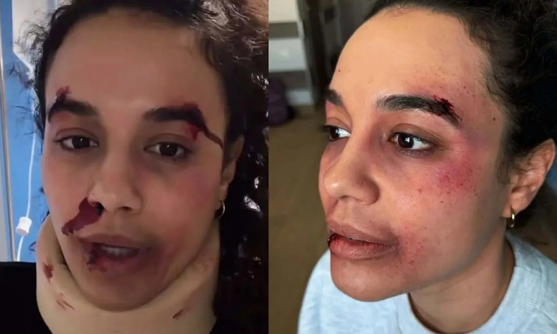 Πηνελόπη Πλάκα με μώλωπες και αίματα : «Πήρα τη μαμά μου…»